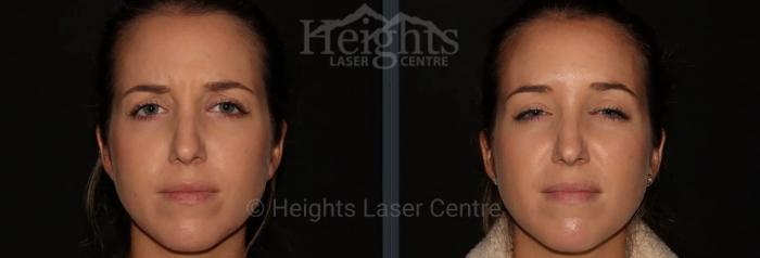 Before & After BOTOX COSMETIC® Case 72 Front View in Vancouver (Burnaby), BC