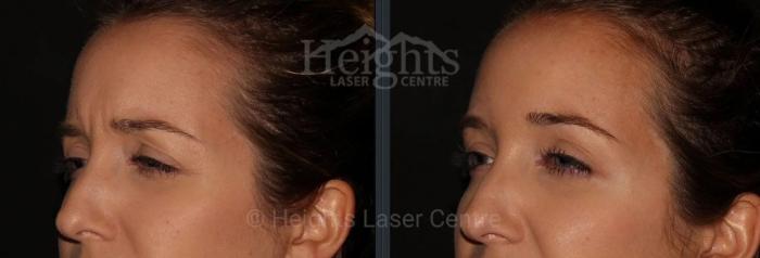 Before & After BOTOX COSMETIC® Case 72 Left Oblique View in Vancouver (Burnaby), BC