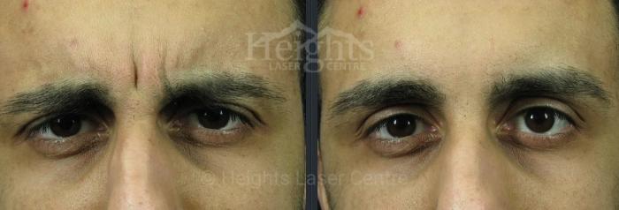 Before & After BOTOX COSMETIC® Case 73 Front Eyes View in Vancouver (Burnaby), BC