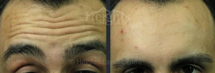 Before & After BOTOX COSMETIC® Case 73 Front View in Vancouver (Burnaby), BC