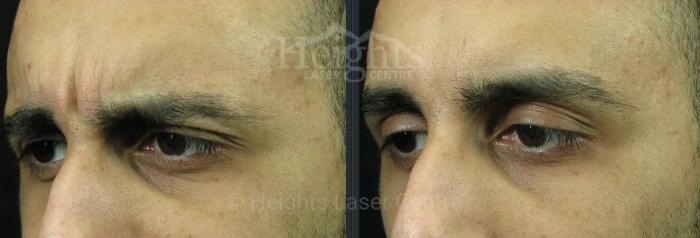 Before & After BOTOX COSMETIC® Case 73 Left Oblique View in Vancouver (Burnaby), BC