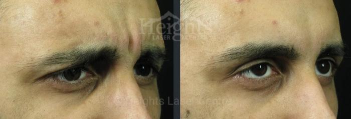 Before & After BOTOX COSMETIC® Case 73 Right Oblique View in Vancouver (Burnaby), BC