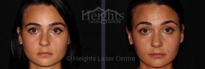 Before & After BOTOX COSMETIC® Case 74 Front View in Vancouver (Burnaby), BC