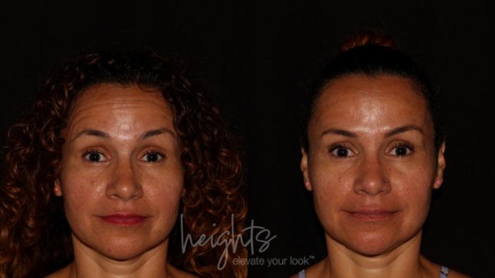 Before & After BOTOX COSMETIC® Case 78 Front View in Vancouver (Burnaby), BC