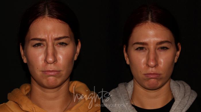 Before & After BOTOX COSMETIC® Case 80 Front View in Vancouver (Burnaby), BC