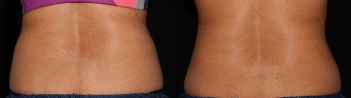 Before & After CoolSculpting® Case 10 Back View in Vancouver (Burnaby), BC