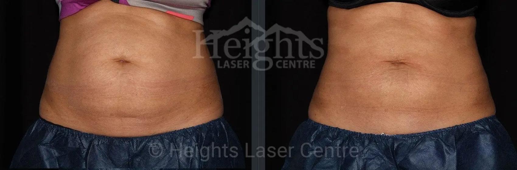 Before & After CoolSculpting® Case 10 Front View in Vancouver (Burnaby), BC