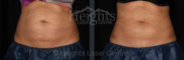 Before & After CoolSculpting® Case 10 Front View in Vancouver (Burnaby), BC
