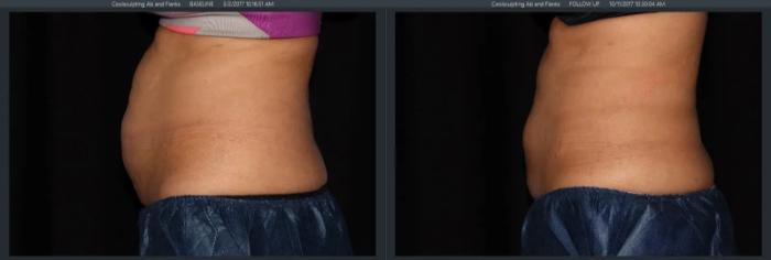 Before & After CoolSculpting® Case 10 Left Side View in Vancouver (Burnaby), BC
