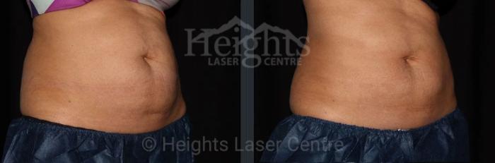 Before & After CoolSculpting® Case 10 Right Oblique View in Vancouver (Burnaby), BC