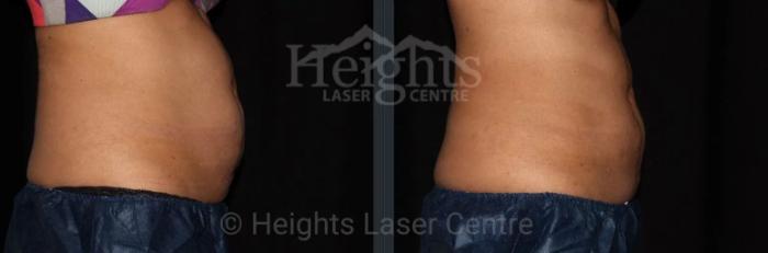 Before & After CoolSculpting® Case 10 Right Side View in Vancouver (Burnaby), BC