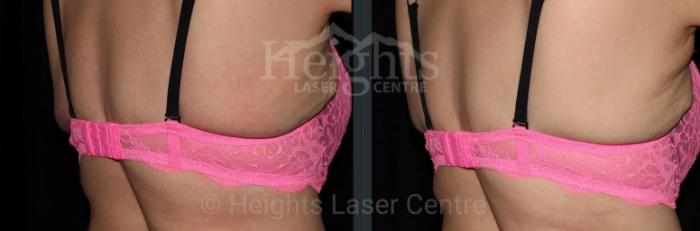 Before & After CoolSculpting® Case 7 Back View in Vancouver (Burnaby), BC