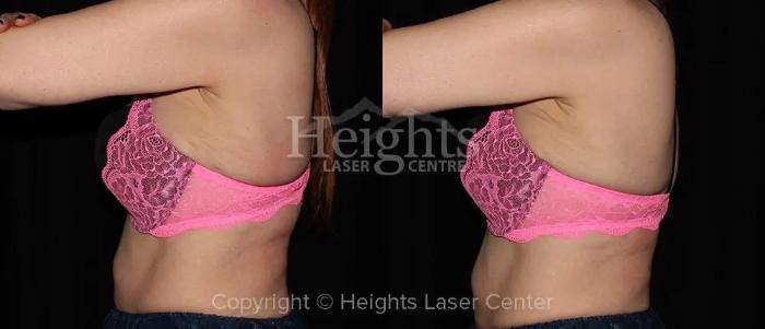Before & After CoolSculpting® Case 7 Left Side View in Vancouver (Burnaby), BC