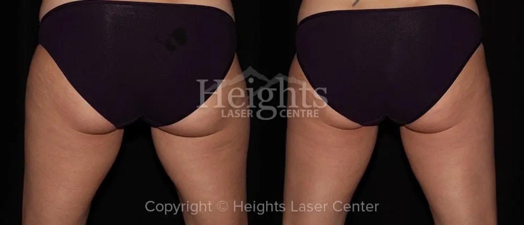 Before & After CoolSculpting® Case 8 Back View in Vancouver (Burnaby), BC