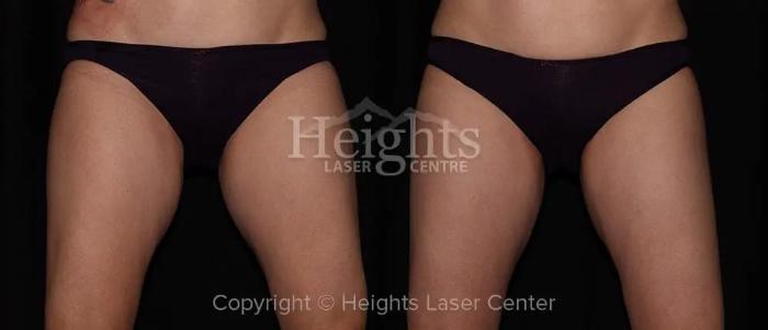 Before & After CoolSculpting® Case 8 Front View in Vancouver (Burnaby), BC