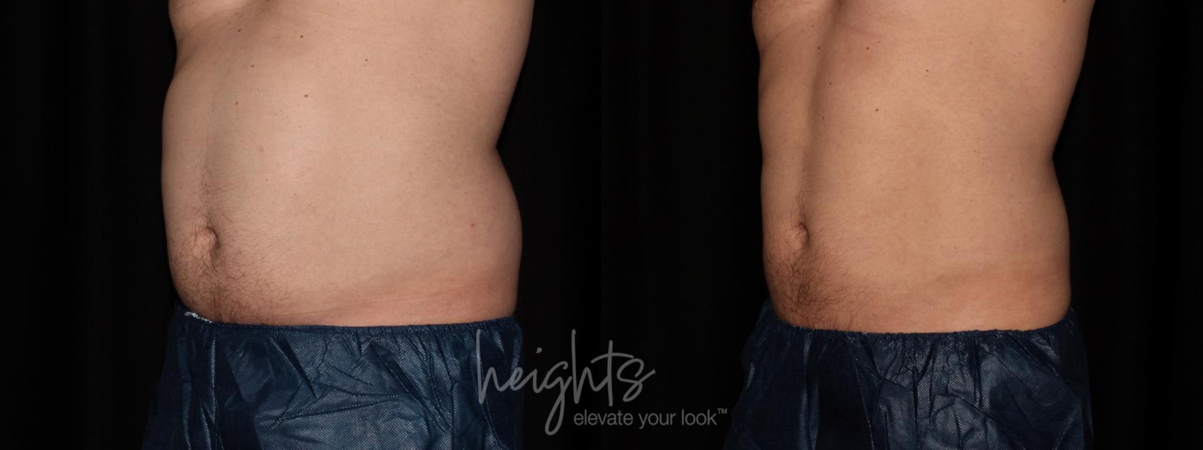 Before & After CoolSculpting® Case 81 Left Oblique View in Vancouver (Burnaby), BC