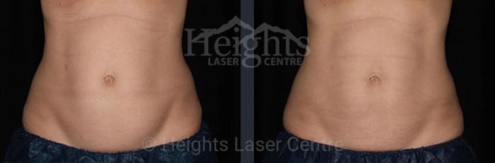 Before & After CoolSculpting® Case 9 Front View in Vancouver (Burnaby), BC