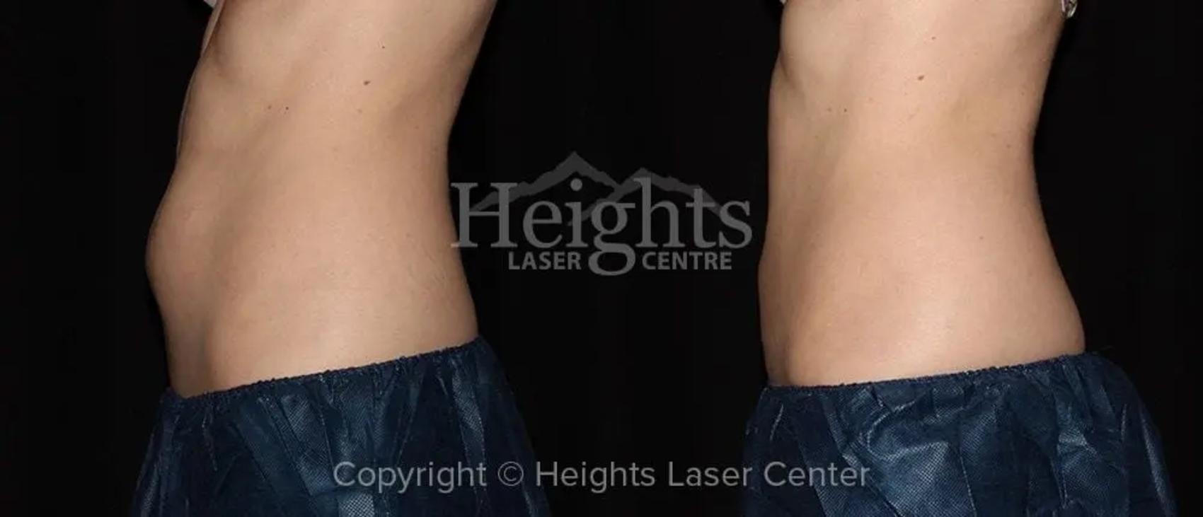 Before & After CoolSculpting® Case 9 Left Side View in Vancouver (Burnaby), BC