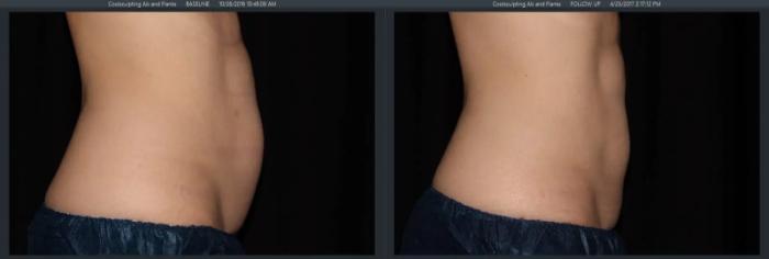Before & After CoolSculpting® Case 9 Right Side View in Vancouver (Burnaby), BC