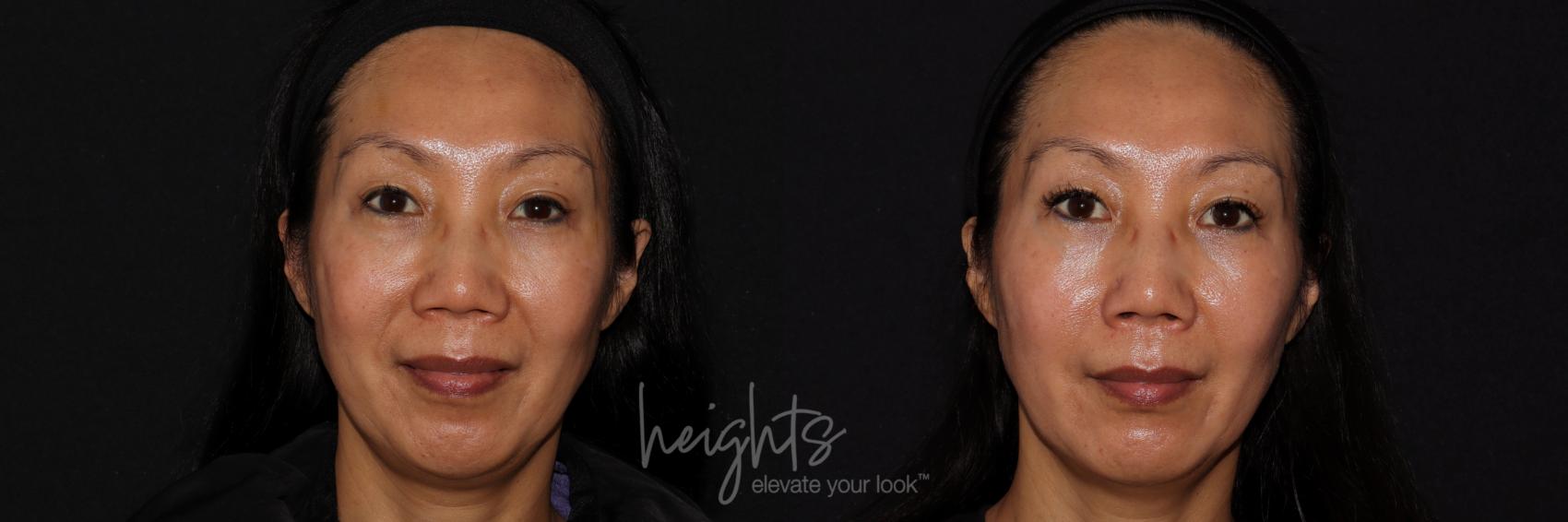 Before & After Dermal Fillers Case 156 Front View in Burnaby & Vancouver, BC