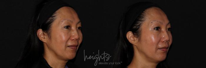 Before & After Dermal Fillers Case 156 Left Oblique View in Burnaby & Vancouver, BC