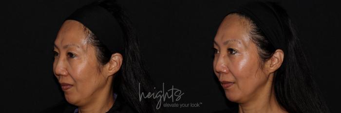 Before & After Dermal Fillers Case 156 Right Oblique View in Burnaby & Vancouver, BC