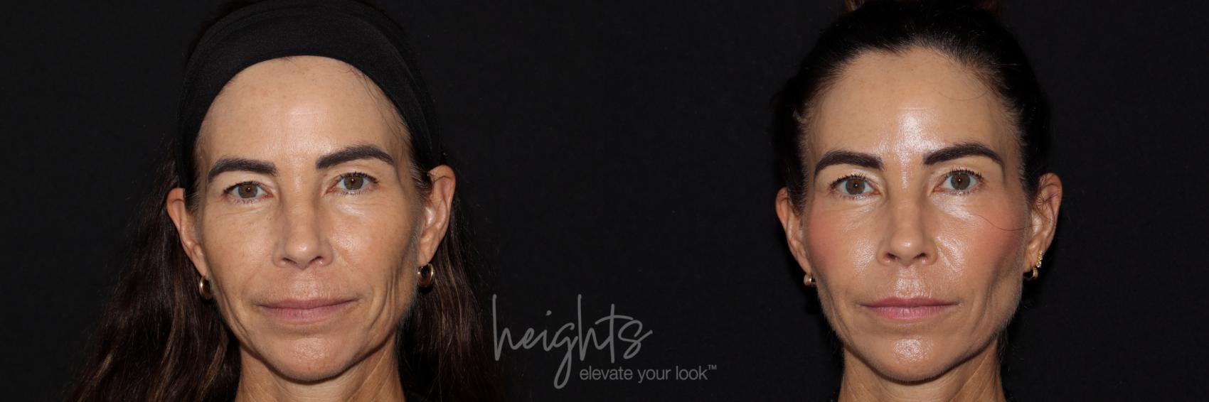 Before & After Dermal Fillers Case 157 Front View in Burnaby & Vancouver, BC