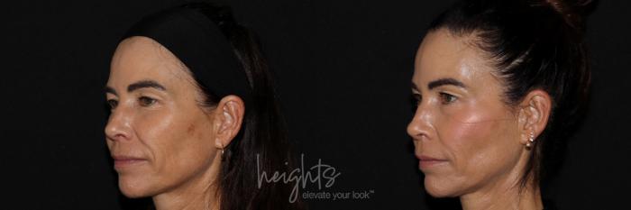 Before & After Dermal Fillers Case 157 Left Oblique View in Burnaby & Vancouver, BC