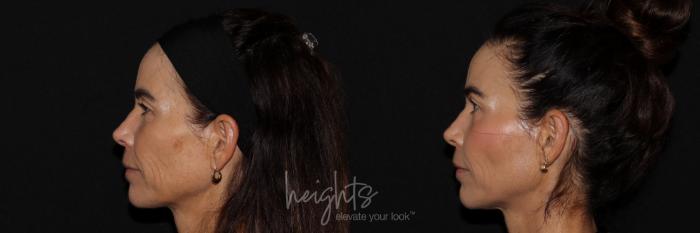 Before & After Dermal Fillers Case 157 Left Side View in Burnaby & Vancouver, BC