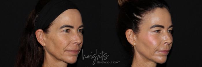 Before & After Dermal Fillers Case 157 Right Oblique View in Burnaby & Vancouver, BC