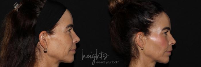 Before & After Dermal Fillers Case 157 Right Side View in Burnaby & Vancouver, BC