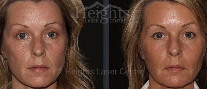 Before & After Dermal Fillers Case 19 Front View in Vancouver (Burnaby), BC