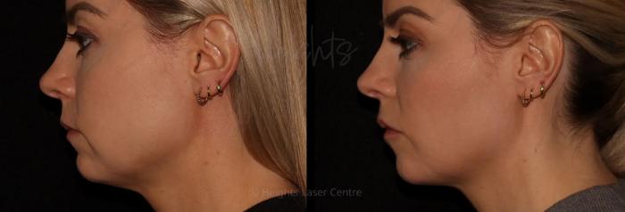 Before & After Dermal Fillers Case 23 Left Side View in Vancouver (Burnaby), BC