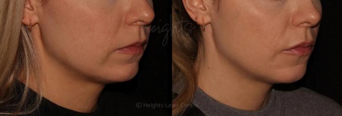 Before & After Dermal Fillers Case 23 Right Oblique View in Vancouver (Burnaby), BC