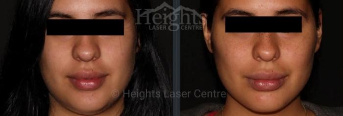 Before & After Dermal Fillers Case 24 Front View in Vancouver (Burnaby), BC