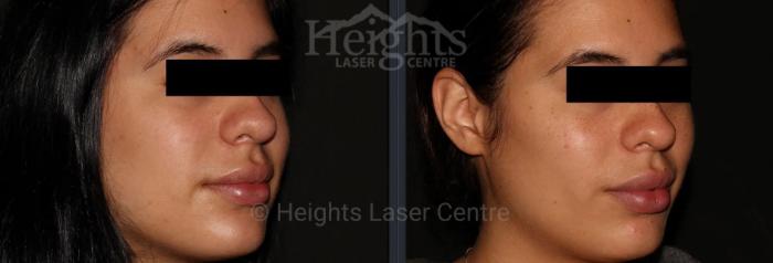 Before & After Dermal Fillers Case 24 Right Oblique View in Vancouver (Burnaby), BC