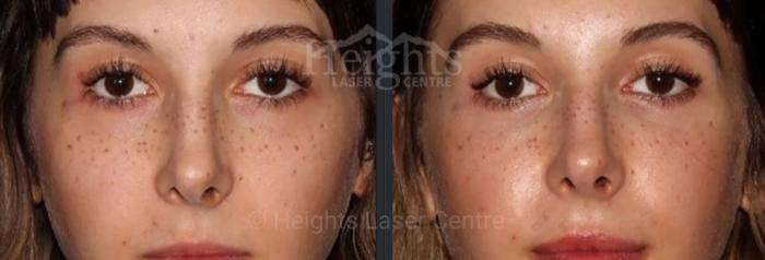 Before & After Dermal Fillers Case 25 Front View in Vancouver (Burnaby), BC