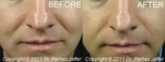 Before & After Dermal Fillers Case 26 Front View in Vancouver (Burnaby), BC