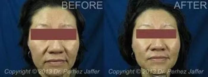 Before & After Dermal Fillers Case 27 Front View in Vancouver (Burnaby), BC