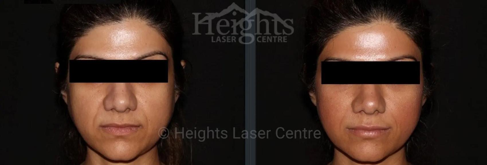 Before & After Dermal Fillers Case 31 Front View in Vancouver (Burnaby), BC