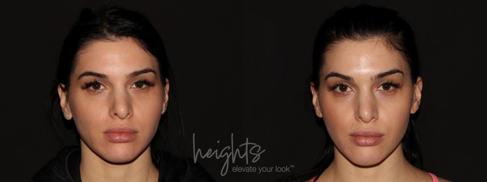 Before & After BOTOX COSMETIC® Case 83 Front View in Vancouver (Burnaby), BC