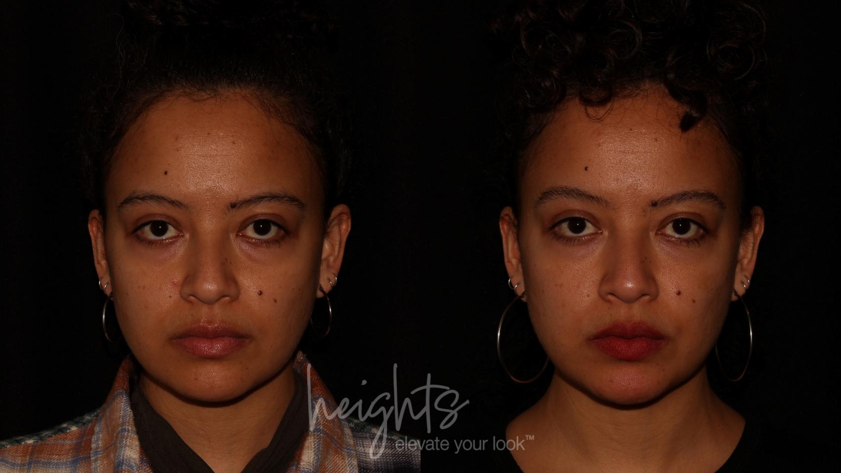 Before & After Dermal Fillers Case 86 Front View in Vancouver (Burnaby), BC