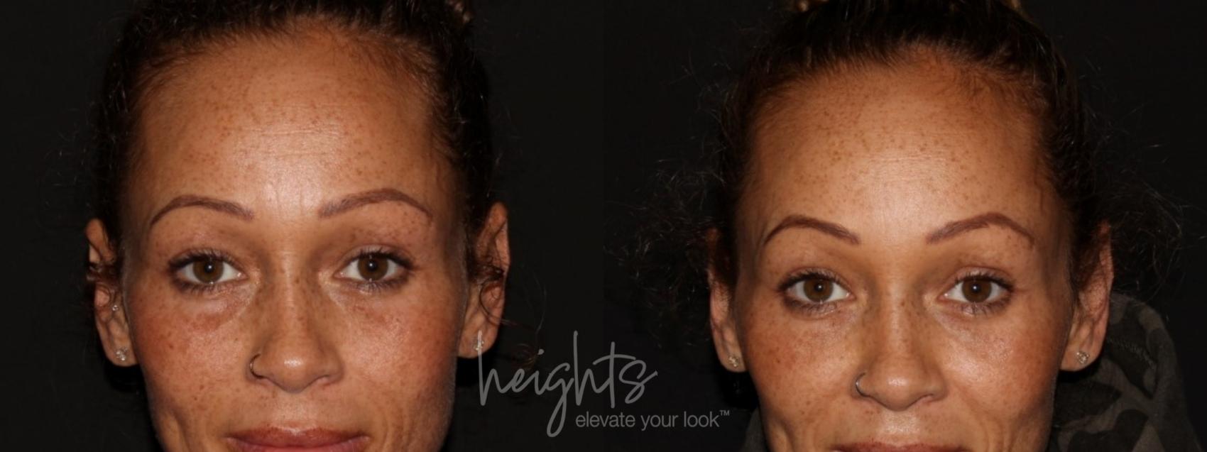Before & After Dermal Fillers Case 87 Front View in Vancouver (Burnaby), BC