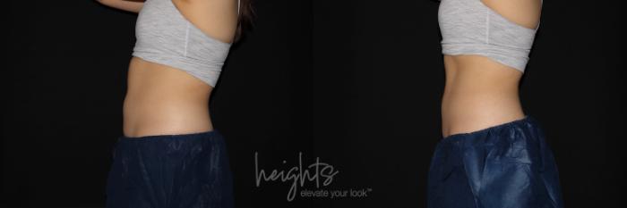 Before & After EMSCULPT NEO® Case 128 Left Side View in Vancouver (Burnaby), BC