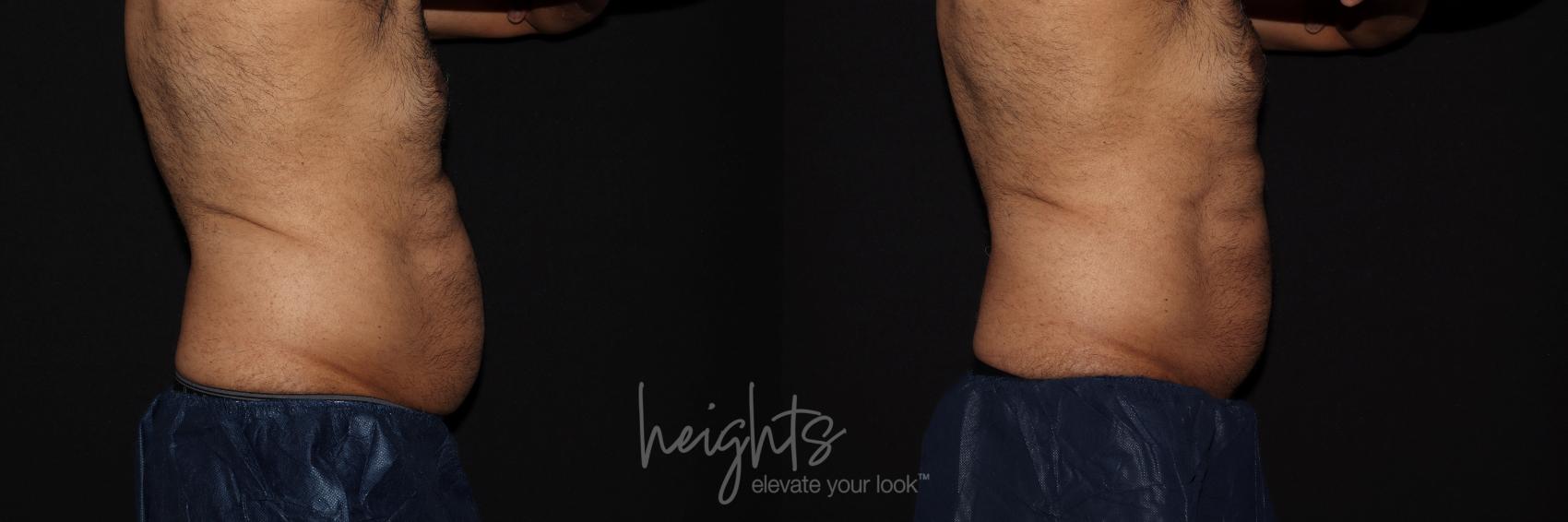 Before & After EMSCULPT NEO® Case 91 Right Side View in Vancouver (Burnaby), BC