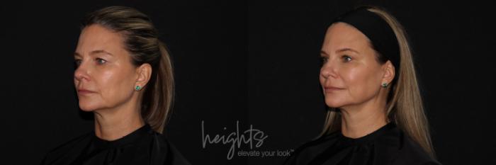 Before & After Eyelid Surgery Case 122 Left Oblique View in Vancouver (Burnaby), BC