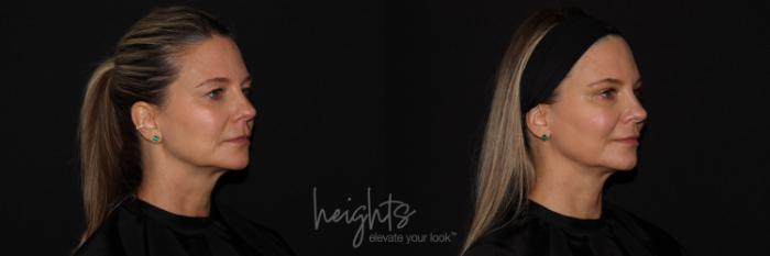 Before & After Eyelid Surgery Case 122 Right Oblique View in Vancouver (Burnaby), BC