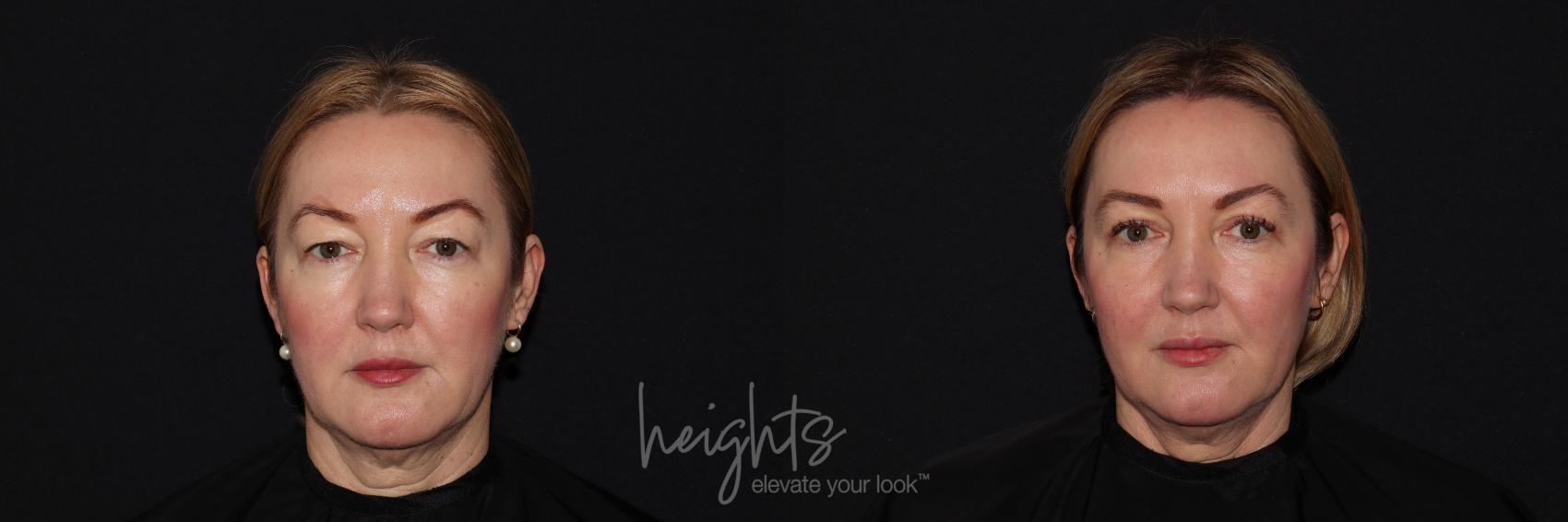 Before & After Eyelid Surgery Case 124 Front View in Vancouver (Burnaby), BC