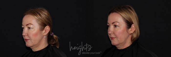 Before & After Eyelid Surgery Case 124 Left Oblique View in Vancouver (Burnaby), BC