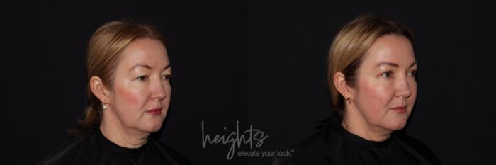 Before & After Eyelid Surgery Case 124 Right Oblique View in Vancouver (Burnaby), BC